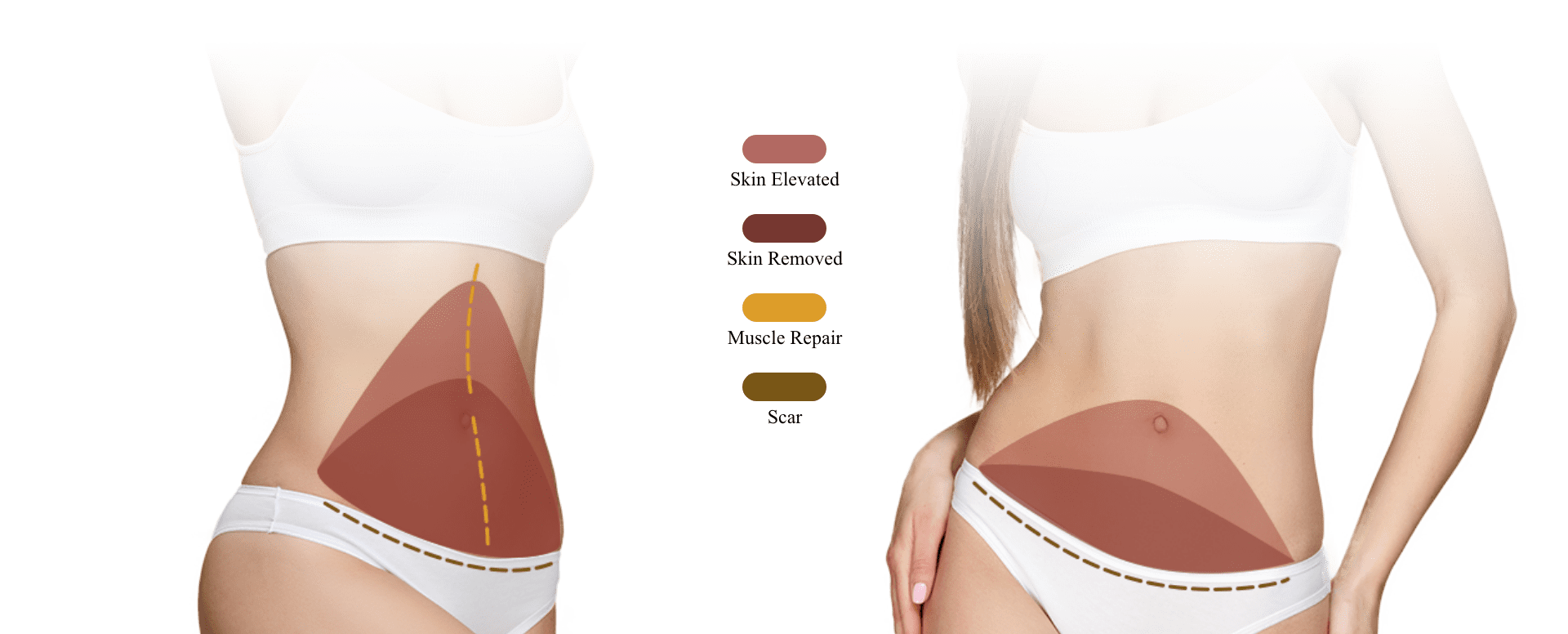 Belt For Tummy Tuck - Flank Or Abdominal Liposuction